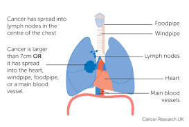 Lung cancer occurs when cells in the lung mutate or change, and most often this happens when people breathe in dangerous, toxic substances. Stage 3 Lung Cancer Cancer Research Uk