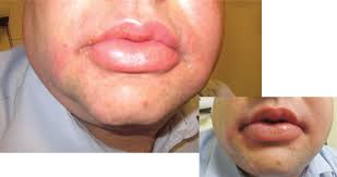 Autor des themas minou balou. Warum Wird Die Lippe Immer Wieder Dick Springerlink