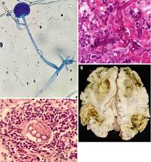Clinical presentation the presentation can vary, ranging from exophthalmos, rhinorrhea, and ophthalmoplegia. Histopathology Springerlink