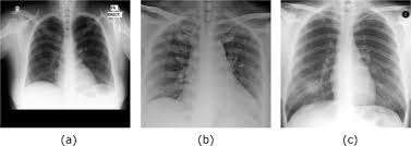 They are classed as a carcinogen. Classification Of Covid 19 In Chest X Ray Images Using Detrac Deep Convolutional Neural Network Springerlink