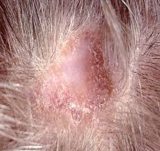Certain conditions can cause an itchy scalp and hair loss. Coping With Hair Loss Lupus Uk