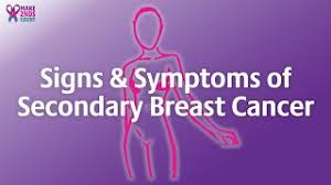 Types of breast cancer, inflammatory breast cancer & stages. Signs Symptoms Of Secondary Breast Cancer Youtube