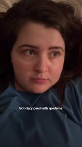 Lipedema Shaughna Phillips