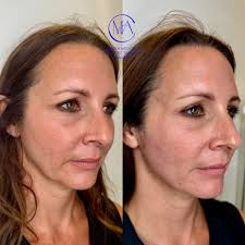 Very subtle PDO thread lifting for the drooping jowls and sagging middle  face 🤩 PDO threads offer the very latest technology for soft,  natural-looking thread lifting in a non-invasive procedure. The PDO