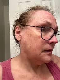 I got the pneumococcal vaccine last Tuesday. After that the symptoms got  worse, e.g. blood sugar rose to 19.6 and this morning the urine was  orange-red. Tearing, throbbing and stiffening pain is