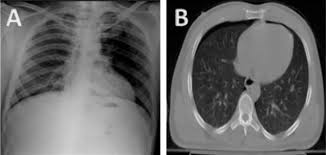 (b) ct demonstrates the large right basal pneumothorax with air in the anterior, least dependent portion of the chest just above the hemidiaphragm. Anteroposterior Chest Radiograph Vs Chest Ct Scan In Early Detection Of Pneumothorax In Trauma Patients International Archives Of Medicine Full Text