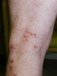 Image result for Varicella zoster on human skin