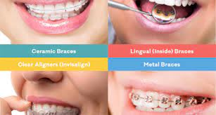 Jul 06, 2021 · how long does it take to straighten teeth with braces? Can I Straighten My Teeth Without Braces Ocean Orthodontic Clinic