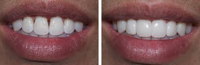 Here we have everything you need. Bioclear Dental Treatment Uk
