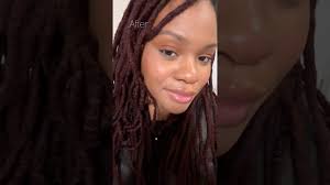 Lip filler chronicles 🤭