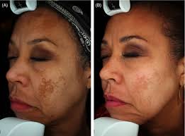 The Tam formula: A pilot study for a new treatment for melasma