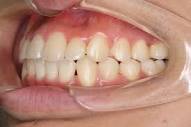 反対咬合の矯正治療例 - 神田ふくしま歯科