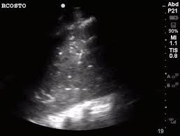 Image result for Air Bronchogram