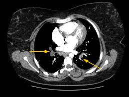 Los síntomas más habituales de la trombosis venosa profunda son Continuum Mujer Adolescente Con Insuficiencia Respiratoria Progresiva Y Hemoptisis