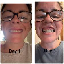 Can you have 2 root canals in same tooth