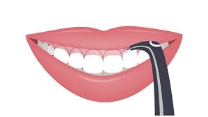 The upper lip is actually a series of muscles, and what botox does is reduce muscle activity. How To Fix A Gummy Smile Ultimate Guide To Gummy Smile Reduction