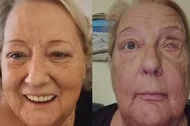 Fundraiser for Bonnie Stack by Terrie Mourningdove : How good it is to own  2 eyes