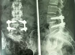 Qu Est Ce Qu Une Arthrodese Lombaire Par Voie Mini Invasive Centre Du Rachis Angers Lombaire Mini