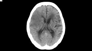 Contralateral hemiplegia which is initially flaccid (floppy do not start statin treatment immediately after an acute stroke but continue statin treatment for people. Acute Ischemic Stroke Cerebral Perfusion Prior To And After Treatment
