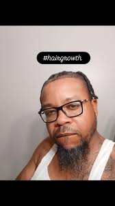 Striving to grow hair, what yall think?