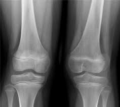 X Ray With Weight Bearing On Both Knees Download Scientific Diagram