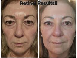 What is a good beginner-friendly retinol?