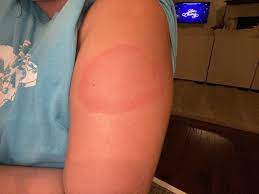 'covid arm' rash seen after moderna vaccine annoying but harmless, doctors say. Latest On Covid Vaccine Side Effects Moderna Arm New York Daily News