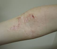 Image result for Atopic eczema atopic dermatitis