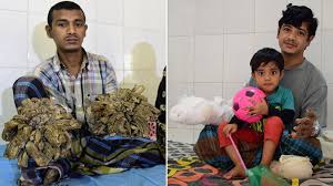 It's a serious #skin condition where tree bark like warts grows on the skin!pic.twitter.com/ld3pycmg1l. Bangladeshi Girl May Be First Female With Tree Man Syndrome Bbc News