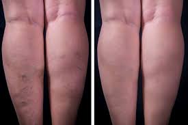 Como Hacer Pomada Para Las Varices