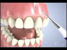 The professional way to remove tartar periodic dental cleanings remove tartar buildup. Dental Scaler And Mirror By Dentek Youtube