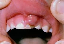 Check spelling or type a new query. Gusi Bengkak Dan Sakit Gigi Pada Anak Balita Kidz Dental Care