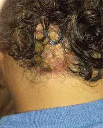 It was bumpy and dry all over, like it. Scalp Mass Is Painful And Oozes Pus Clinician Reviews