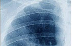 Mesothelioma is a rare form of cancer that affects the cells that make up the. Asco 2020 Durvalumab Added To Standard Chemotherapy Improved Overall Survival In Mesothelioma Ecancer