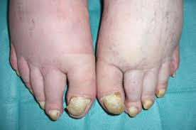 Image result for Onycholysis feet