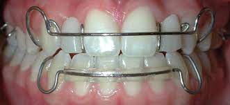 Retainers Just After Medicaid Braces Retainers Retainer Teeth Clear Retainers