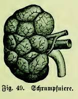 Schrumpfniere Wikipedia