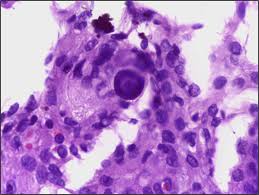 Check spelling or type a new query. Psammoma Body Wikipedia