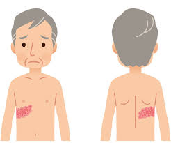 Image result for shingles in children