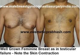 Learn what to watch for here. Gynecomastia Surgery India Best Male Breast Reduction Cost Delhi