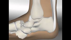 Charcot foot syndrome (cfs) is one of the more devastating complications affecting patients with diabetes and peripheral neuropathy. Demo Charcot Reconstruction With Tal Youtube