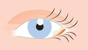 Rote Augen Ursachen Symptome Und Behandlung Apollo