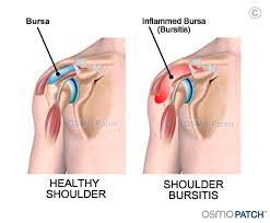 You might be suffering from shoulder bursitis if: Shoulder Bursitis Back In Action