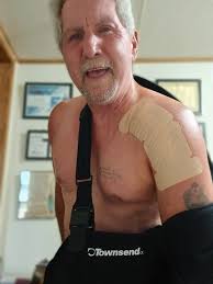 After nearly 18 months my left arm is nearly back to normal. I suffered a  set back at 12 months when a nurse yanked