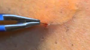 Inning accordance with livestrong, genital herpes and lesions are frequently puzzled with ingrained infected ingrown hairs are likely to injure and have a yellow discharge. Ingrown Hair On Pubic Area Male