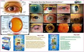 If You Have This Eye Problem Please Take Our Big 3c S Choleduz Complete And C24 7 Natural Food Supplements Eyes Problems Complete Nutrition