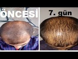 100 Sac Cikaran Sampuan Sac Dokulmesine Karsi Kesin Cozum Sac Cikartan En Iyi Formul Kadin Erkek Youtube