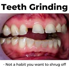 The problem with teeth grinding (as if we need more problems!) is that over time it can cause jaw disorders, headaches, and worn, fractured, chipped or so, how do we stop grinding our teeth? Grinding Your Teeth Dr Wenrick S Blog Dentist Tmj Specialist
