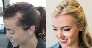 The once daily use foam treatment regrows hair in 81% of the women who try it. Female Hair Transplant Reviews Hair Loss Treatment Female Styleoflady
