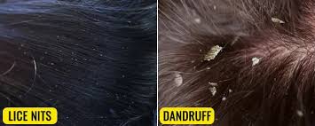 Image result for lice vs dandruff